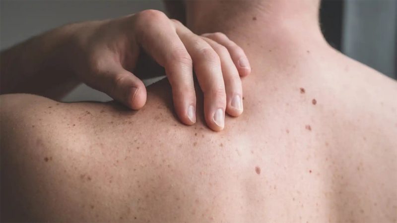 Melanoma: el diagnóstico precoz es clave ante la forma más peligrosa de cáncer de piel